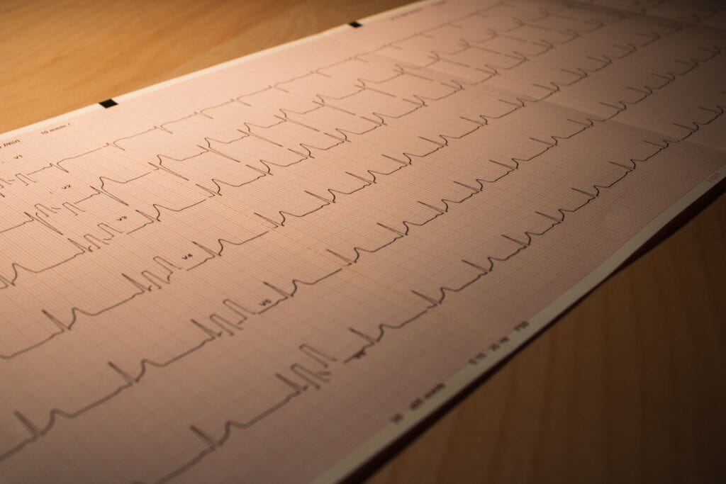 ECG tracing used during assessment of chest pain and heart rhythm symptoms.